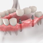歯を失った場合の補綴治療法にインプラントを選択するメリットとは