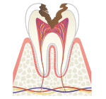 神経までの虫歯